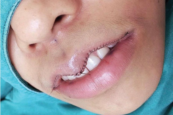 Phẫu thuật môi